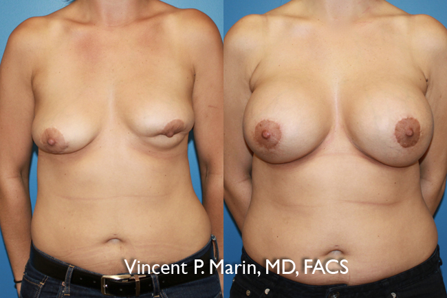 breast augmentation revision