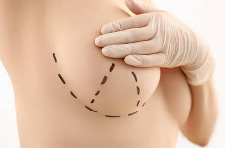 Drop and Fluff: The Breast Implant Settling - Dr. Vincent P. Marin - Marin  Aesthetics