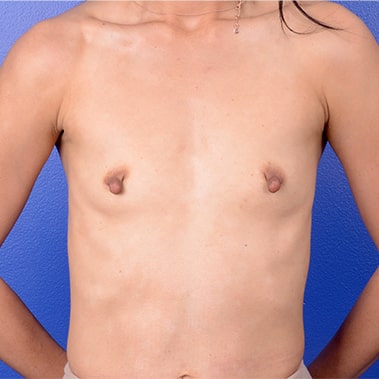 Gummy Bear Breast Implants San Diego Augmentation