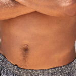 Tummy Tuck for Men: Everything You Need to Know