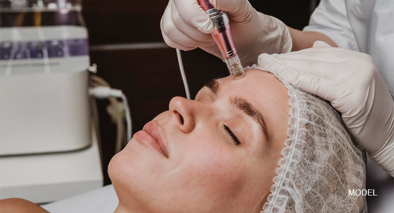 microneedling for wrinkles