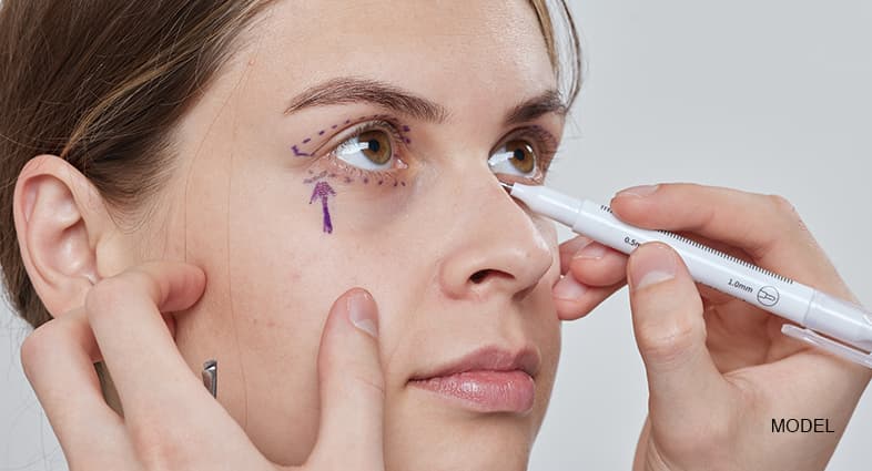 Microneedling Under Eye bags