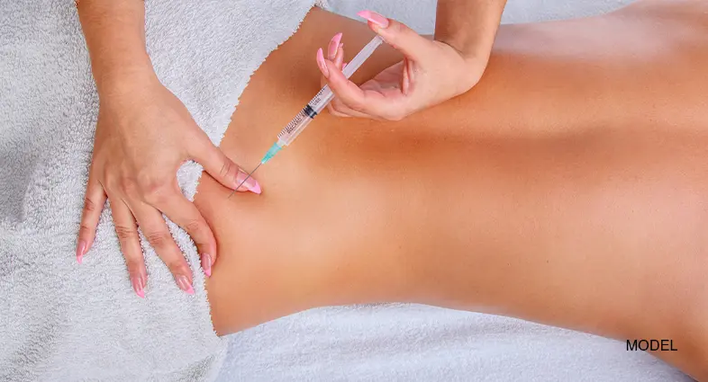 microneedling for stretch marks