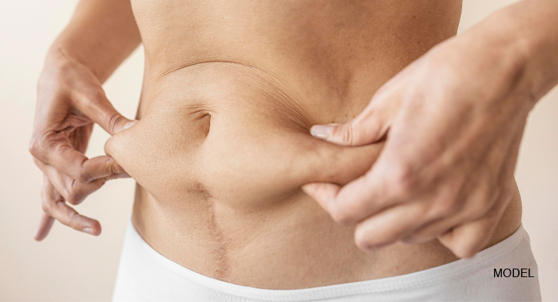 One Year After Liposuction