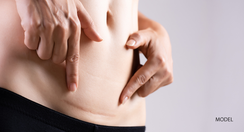 Excess Skin Removal